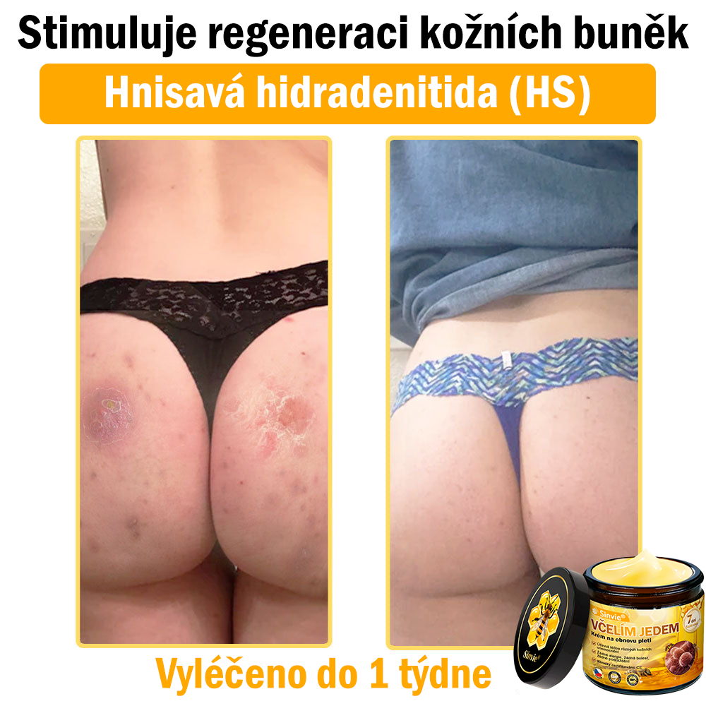 🐝🐝 Sinvie® Krém na obnovu pleti s včelím jedem 👨⚕ Doporučeno dermatology ✅GMP schváleno - 50ml