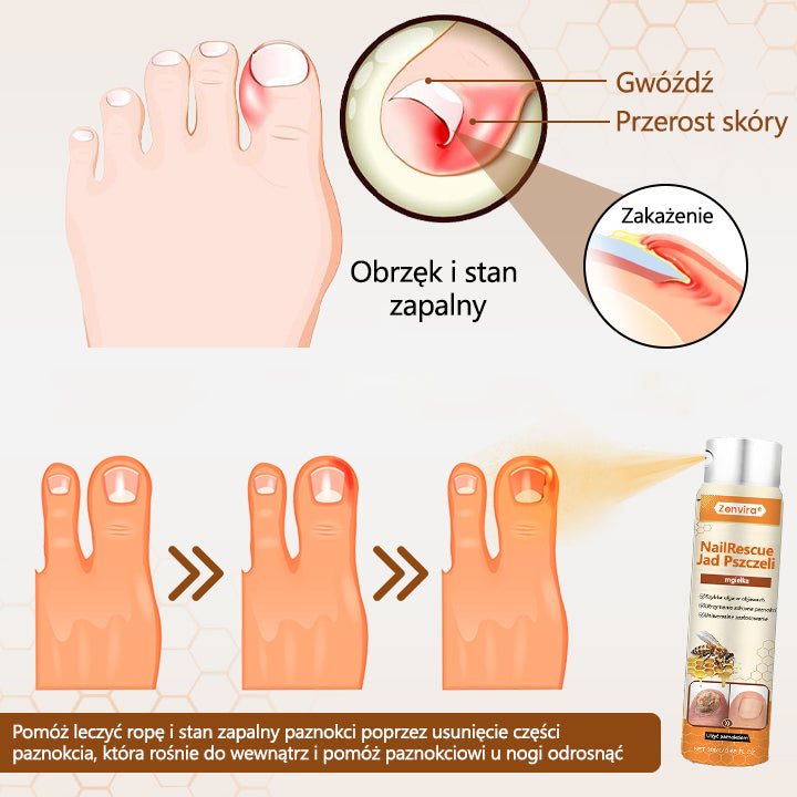 【Doporučeno odborníky】💛Zenvira® NailRescue Přírodní Sprej — ✅ Prokázaná účinnost proti lámavosti a žloutnutí nehtů během 7 dní!